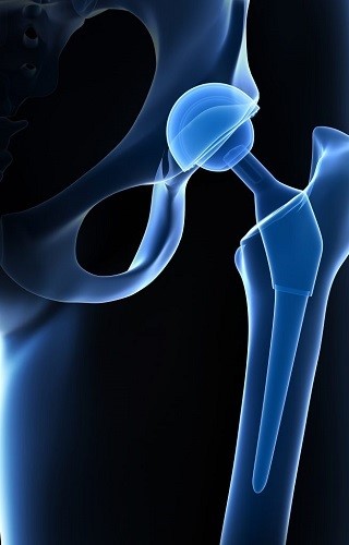 Best Hip  Replacement doctor in patna