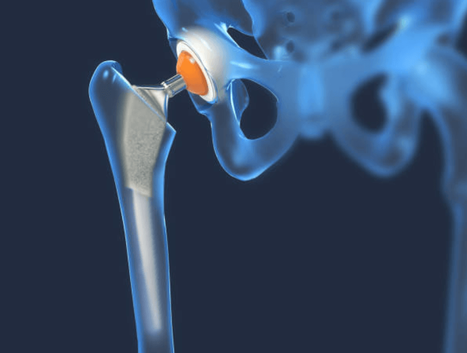 Best Hip Replacement doctor in bihar
