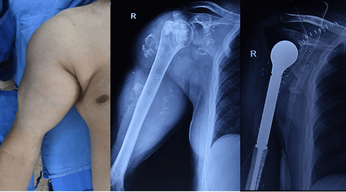 Bone cancer surgery name