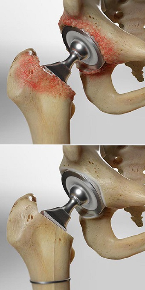 hip arthroplasty
