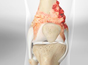 bone cancer symptoms