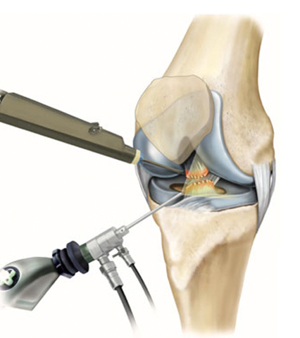 Arthroscopic knee surgery meniscus