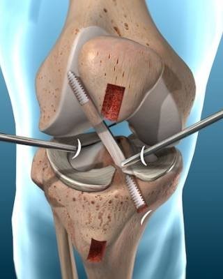 knee arthroscopy