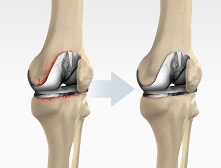 Total knee replacement revision protocol 
