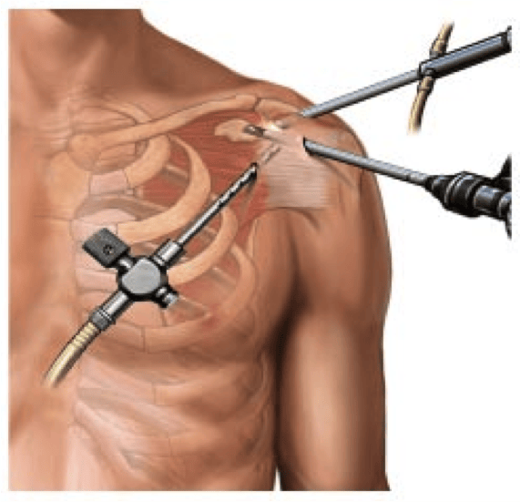 Arthroscopic shoulder surgery recovery time
